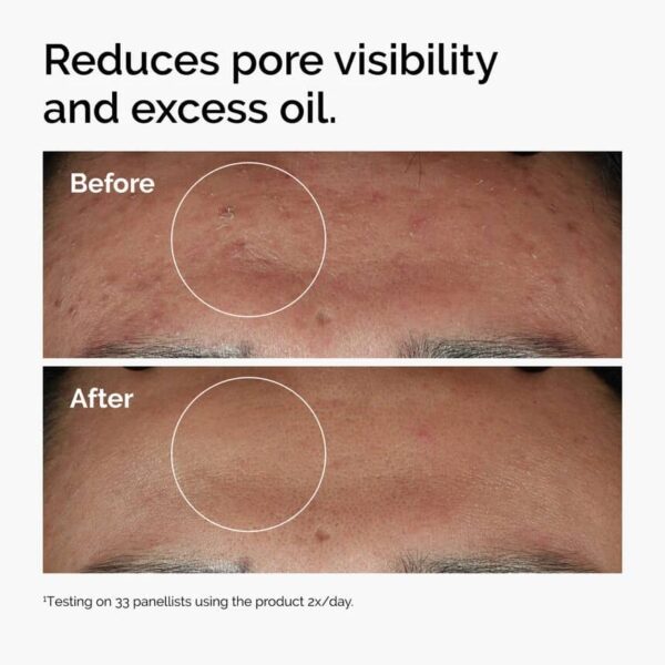 نیاسینامید ۱۰٪ + زینک ۱٪ (Niacinamide 10% + Zinc 1%)